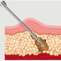 adipose2-fat-graft-cells